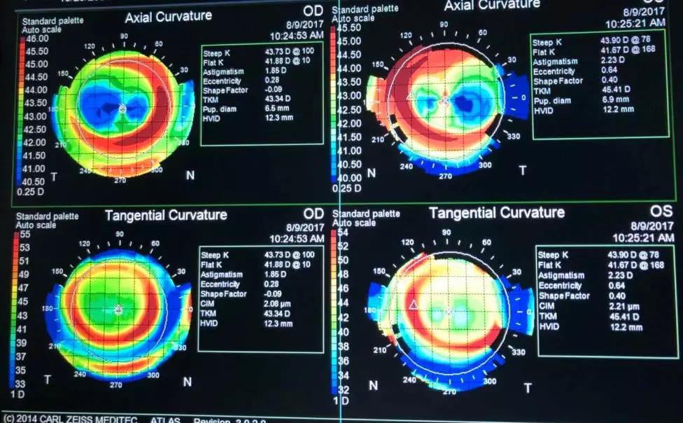 梦梦佩戴半年后角膜地形图